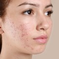 Qual è la migliore cura della pelle per l'acne?