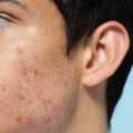 Qual è la migliore routine di cura della pelle per eliminare l'acne?